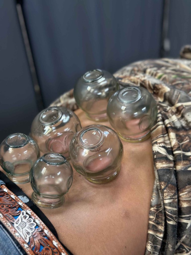 Fire cupping in lubbock tx