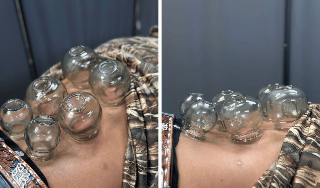 Fire cupping in lubbock tx