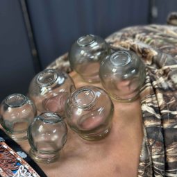 Fire cupping in lubbock tx